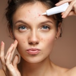 Acne positivity: come cambia il modo di parlare della nostra pelle