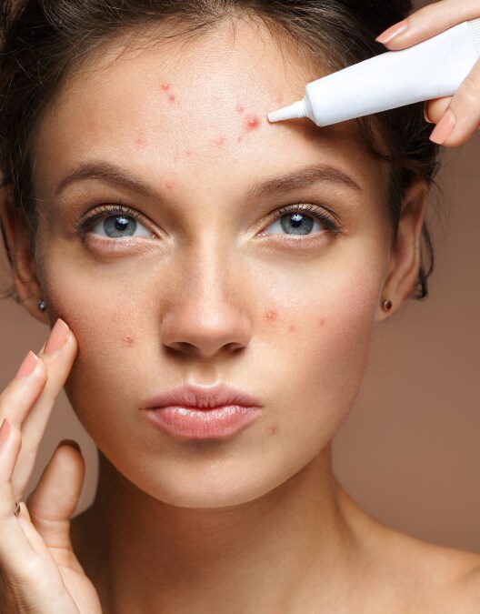 Acne positivity: come cambia il modo di parlare della nostra pelle