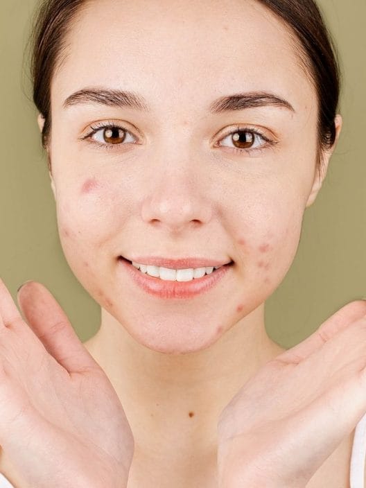 Tipologie di acne e brufoli: come riconoscerle (e combatterle)