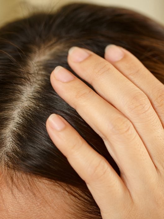 Acne Scalp: Come prevenirla e gestirla al meglio